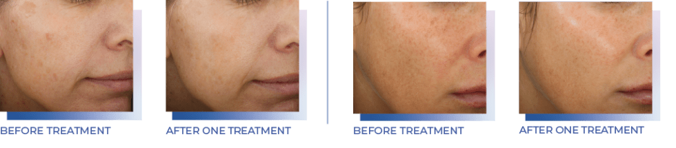 before-after-1024-980x215