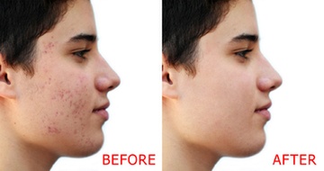 Microneedling with PRP Before & After
