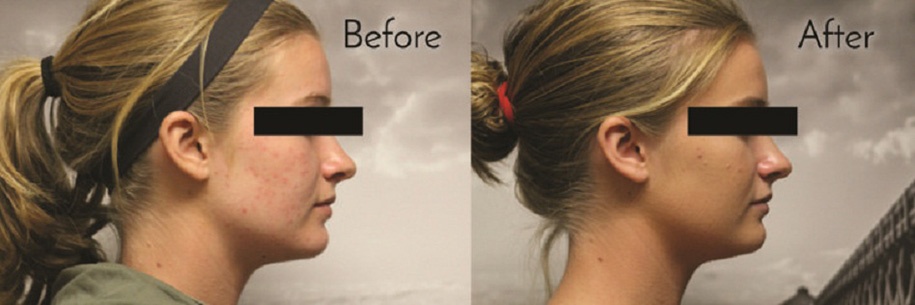 Facial Rejuvenation BEFORE & AFTER
