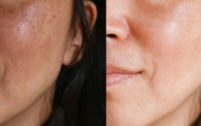 Melasma: What is it? What are the Symptoms? How do you treat it?